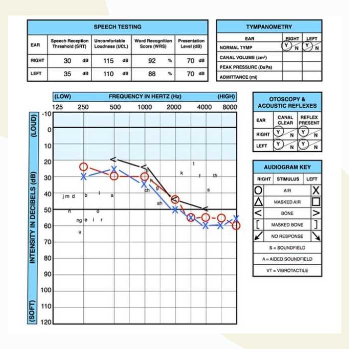How To Read An Audiogram Dr Amy Sarow Explains How To Read An Audiogram Dr Amy Sarow Explains